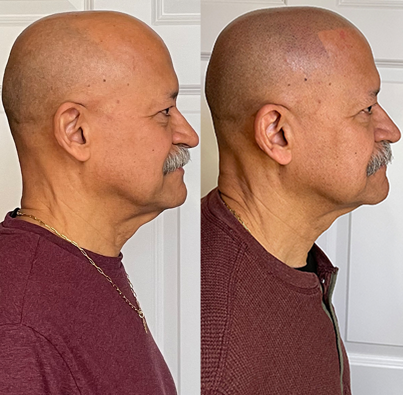 SMP Before and after in boston ma from Scalp Micro Boston