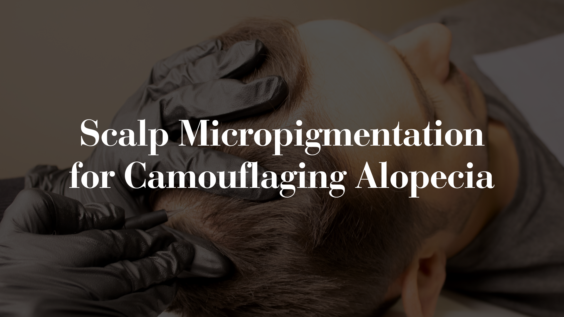 SMP for Alopecia